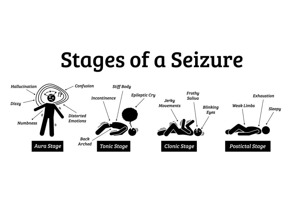 An infographic that says "Stages of a seizure:
Aura stage: hallucination, dizzy, numbness, confusion, distorted emotions. 
Tonic stage: Back arched, incontinence, stiff body, epileptic cry
Clonic stage: Jerky movements, frothy saliva, blinking eyes
Postictal stage: Weak limbs, exhaustion, sleepy"
