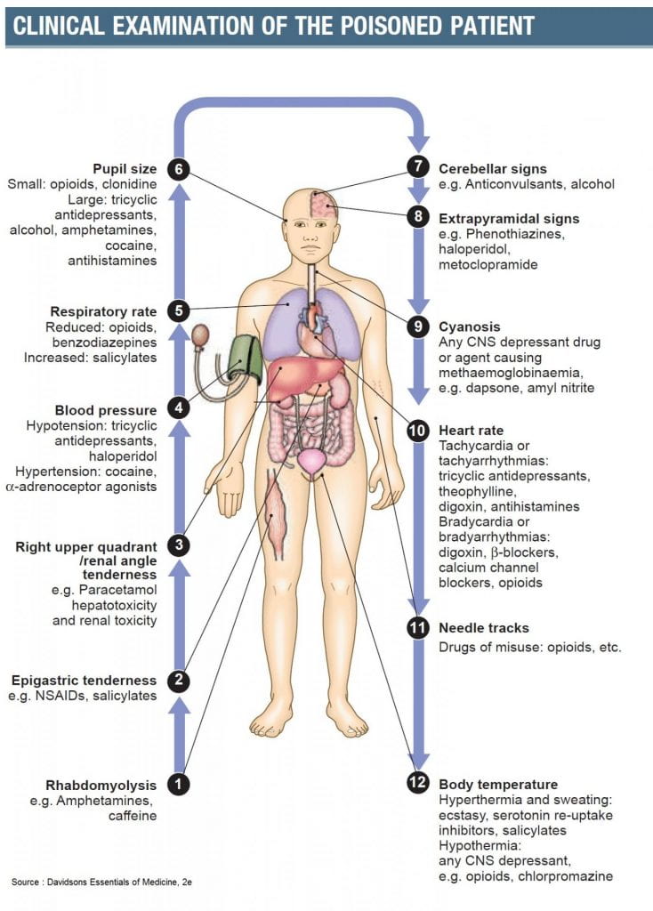 An infographic saying "Clinical examination of the poisoned patient. 1. Rhabdomyolysis e.g. Amphetamines, caffeine. 2. Epigastric tenderness e.g. NSAIDs, salicylates. 3. Right upper quadrant/ renal angle tenderness e.g. Paracetamol hepatoxicity and renal toxicity. 4. Blood pressure - Hypotension: tricyclic antidepressants, haloperidol Hypertension: cocaine, alpha-adrenoceptor agonists. 5. Respiratory rate - Reduced: opioids, benzodiazepines - Increased: salicylates. 6. Pupil size - small: opioids, clonidine - large: tricyclic antidepressants, alcohol, amphetamines, cocaine, antihistamines. 7. Cerebellar signs e.g. Anticonvulsants, alcohol. 8. Extrapyramidal signs e.g. Phenothiazines, haloperidol, metoclopramide. 9, Cyanosis - Any CNS depressant drug or agent causing methemoglobinemia, e.g. dapsone, amyl nitrate. 10. Heart rate - Tachycardia or tachyarrhythmias: tricyclic antidepressants, theophylline, digoxin, antihistamines Bradycardia or bradyarrhythmia's: digoxin, beta-blockers, calcium channel blockers, opioids. 11. Needle tracks - Drugs of misuse: opioids, etc. 12. Body temperature - Hyperthermia and sweating: ecstasy, serotonin re-uptake inhibitors, salicylates. Hypothermia: any CNS depressant, e.g. opioids, chlorpromazine. 
Source: Davidsons Essentials of Medicine, 2e.